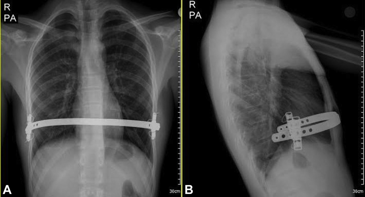 рентген снимок пластины во время лечения киля грудной клетки 