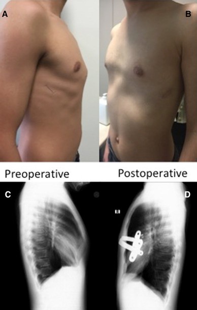 до и после лечения килевидной груди
