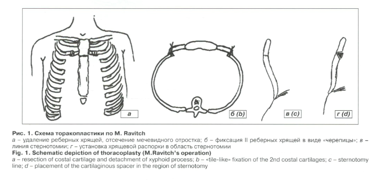 Схема торакопластики по Равич