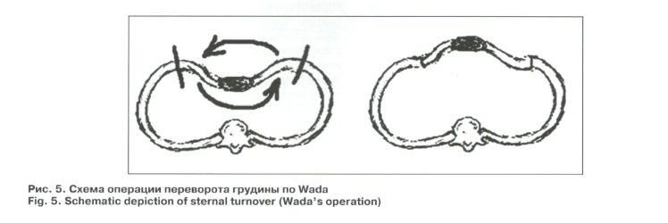 Схема операции переворота грудины по Wada