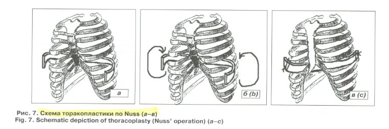 Схема торакопластики по Нассу