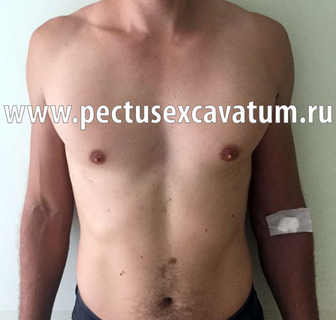 Операция по коррекции впалой груди в Иркутске