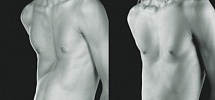 Клиническая картина воронкообразной груди