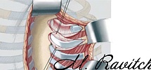 Хирургическое лечение: Коррекция воронкообразной деформации грудной клетки по Равичу